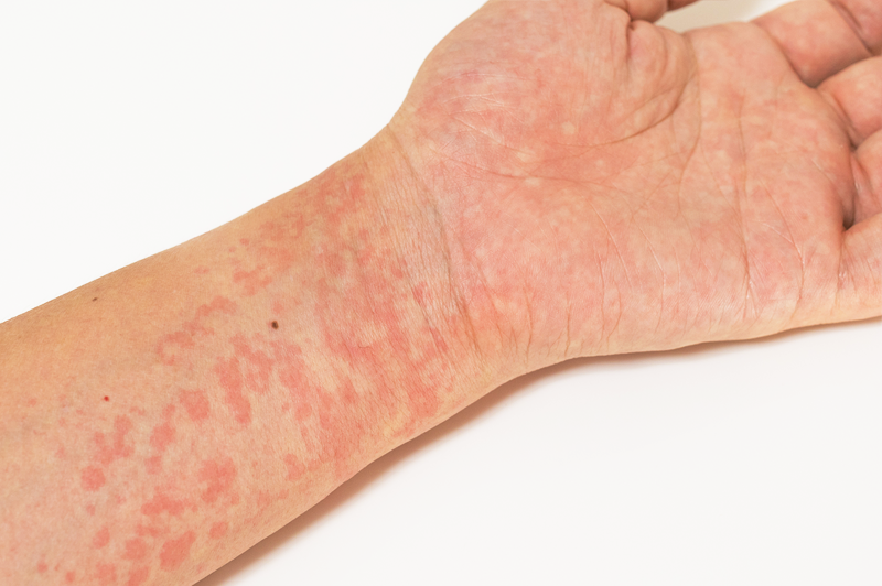 ニコチンアレルギーはどのように診断されますか?