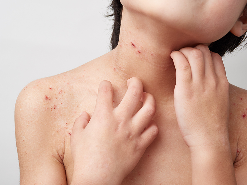 アトピー性皮膚炎の症状の一例
