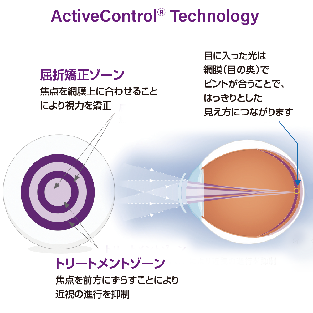 MiSight® 1 dayによる近視抑制（軸性近視）のイメージ図