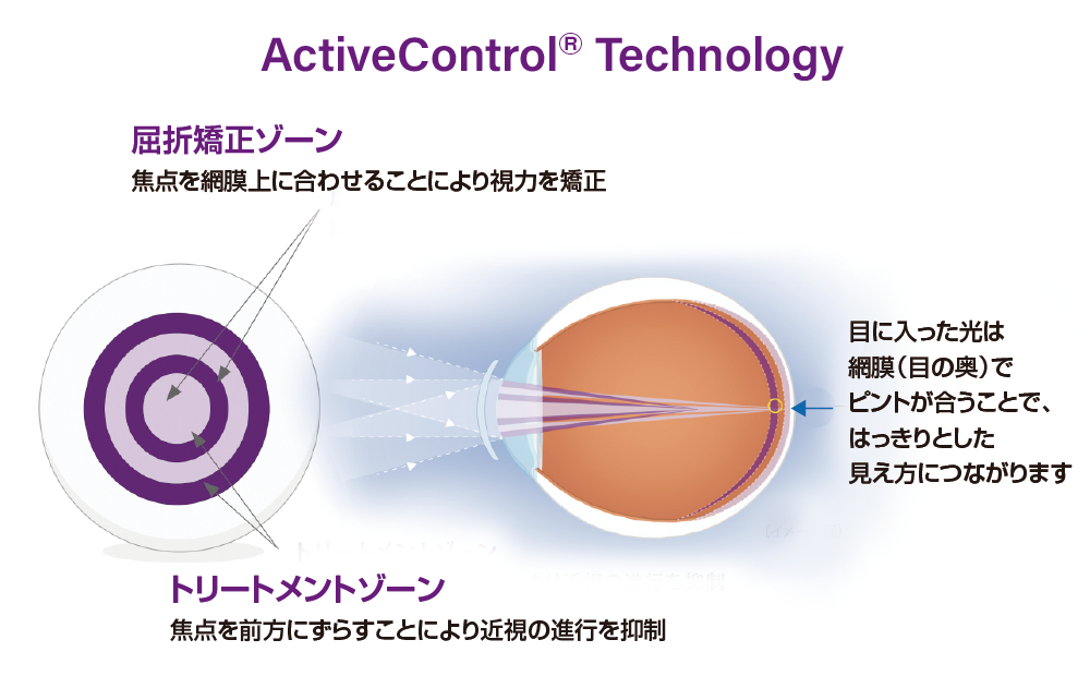 MiSight® 1 dayによる近視抑制（軸性近視）のイメージ図