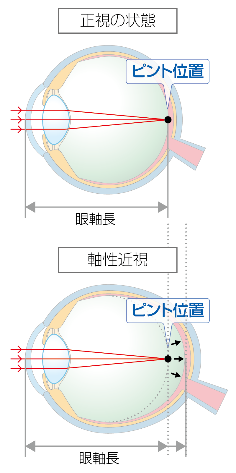 軸性近視のイメージ図