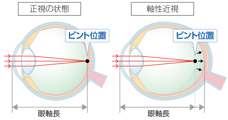 軸性近視のイメージ図