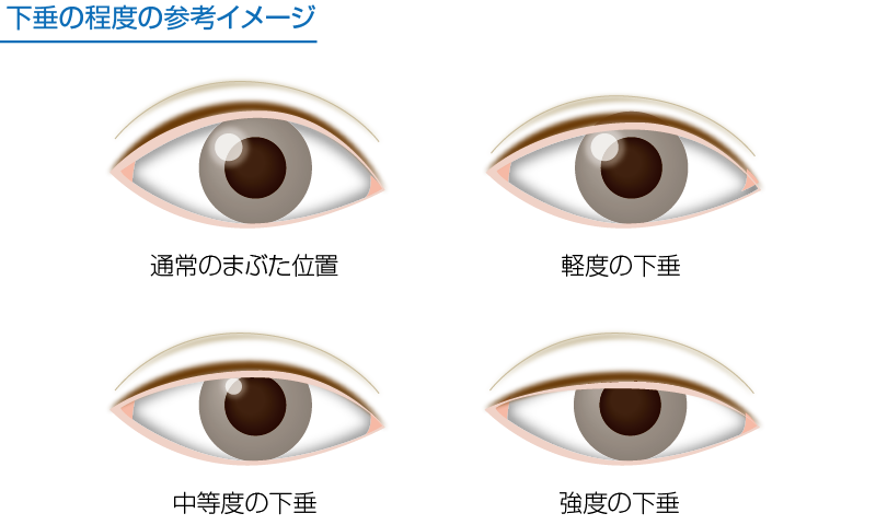 眼瞼下垂 程度の比較