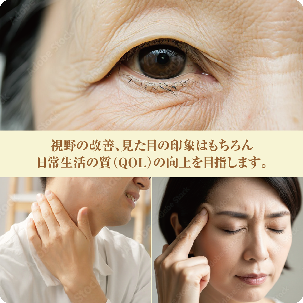 眼瞼下垂イメージ