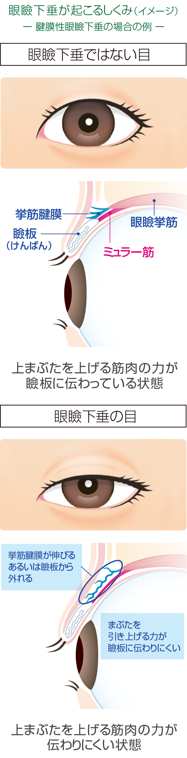後天性眼瞼下垂のイメージ図